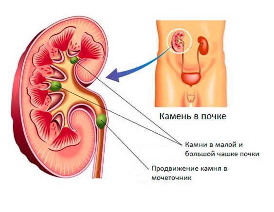 Камни в почке