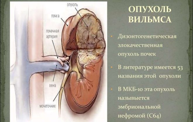 Опухоль Вильмса у детей