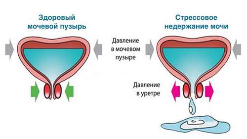 Механизм стрессового недержания мочи