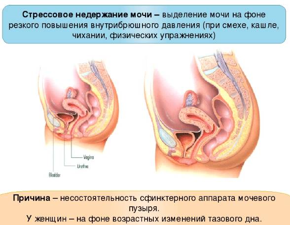 Женское стрессовое недержание мочи