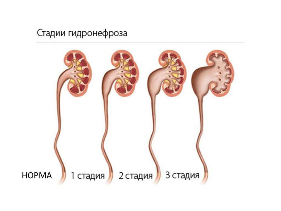 Гидронефроз разной степени