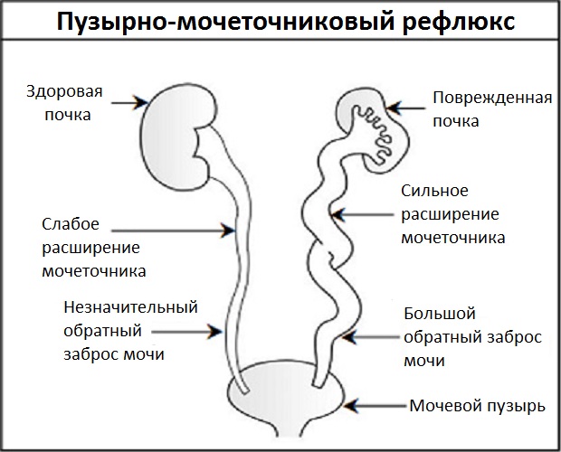 Пузырно-мочеточниковый рефлюкс