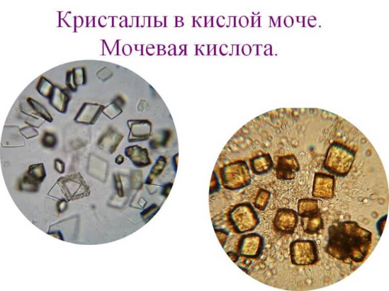 Ураты в осадке мочи (картина под микроскопом)