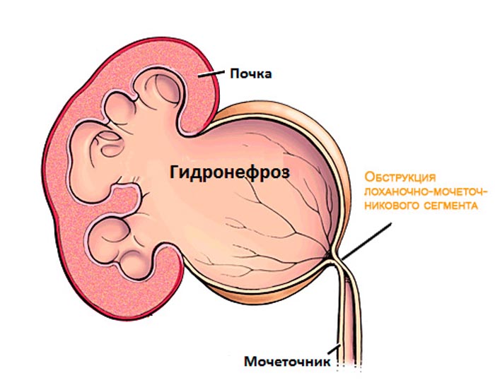 Гидронефроз почки