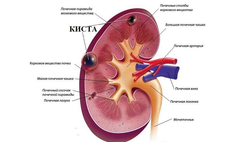 Киста почки