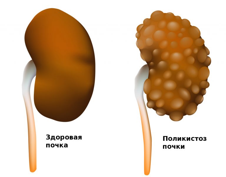 Поликистоз