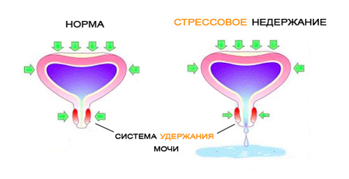 Стрессовое недержание мочи