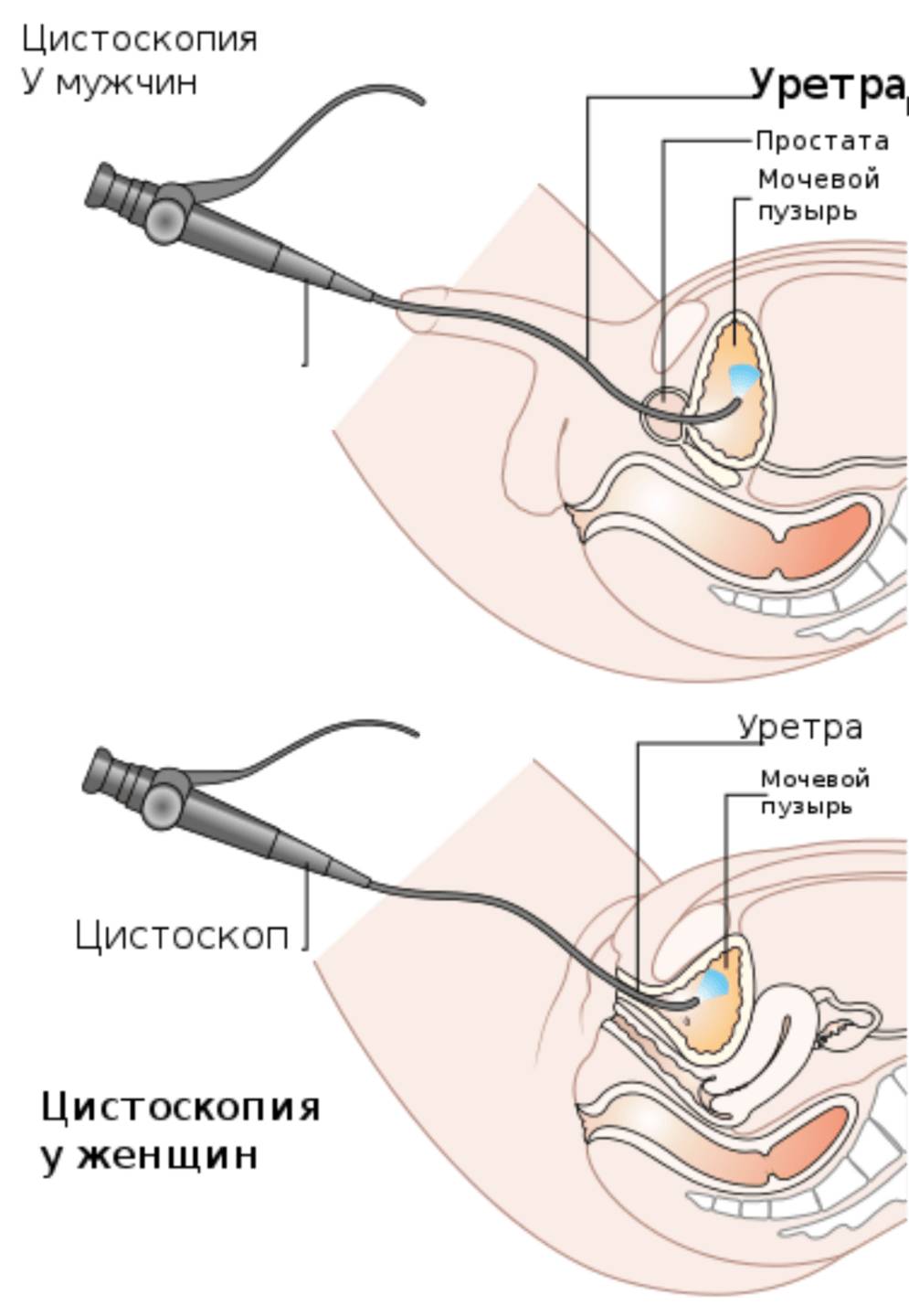 Цистоскопия