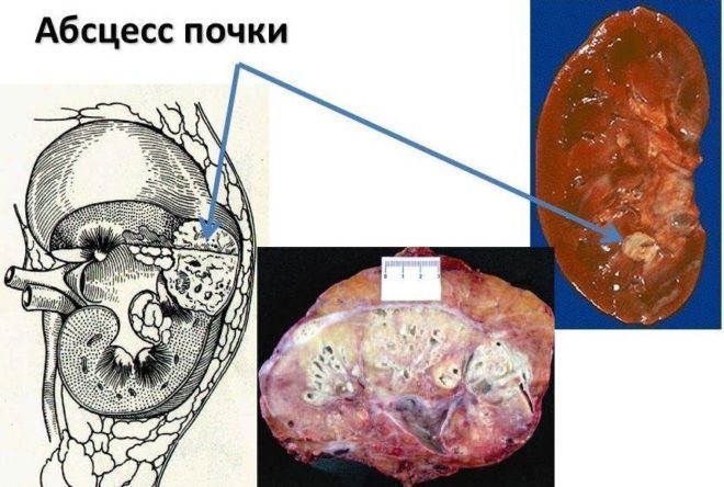 Абсцесс почки