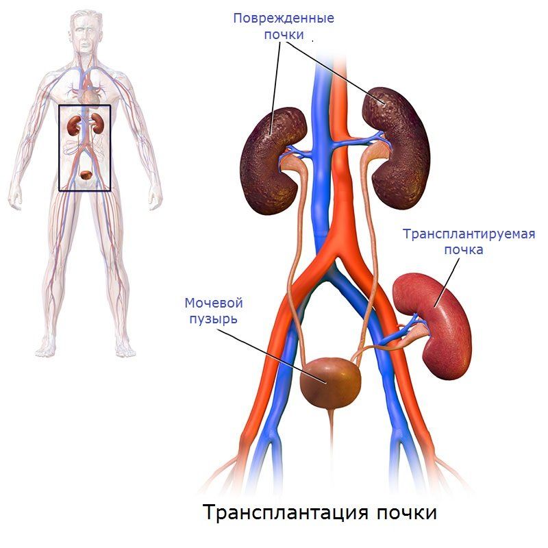 Операция по пересадке почек