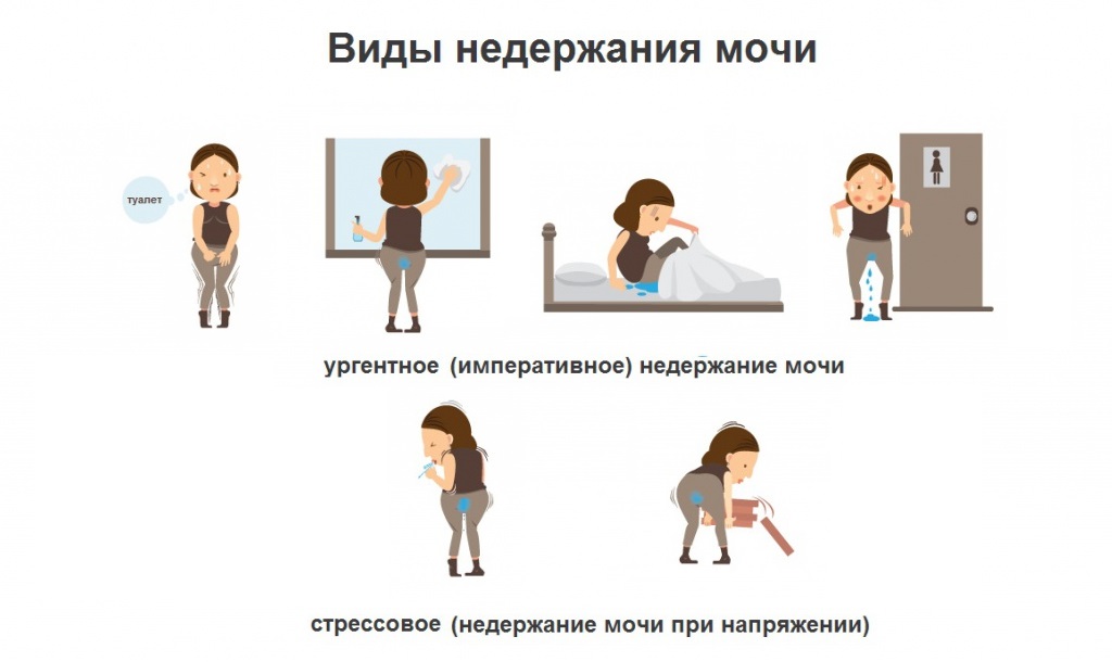 Виды недержания мочи