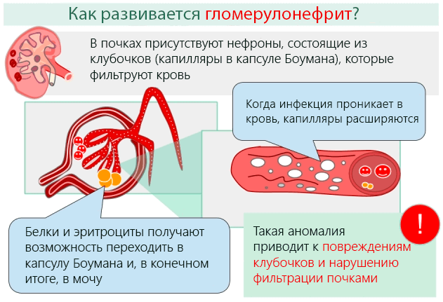 Гломерулонефрит