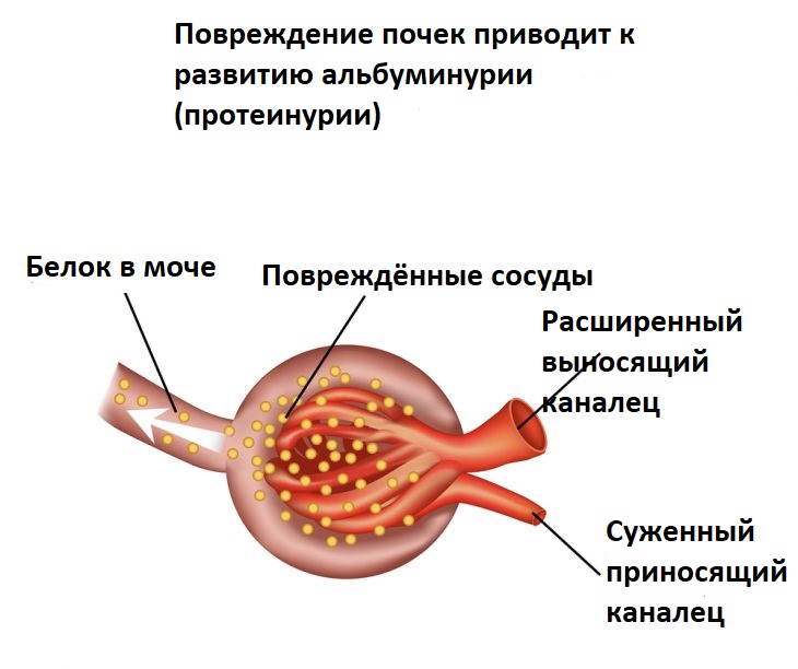 Патогенез альбуминурии