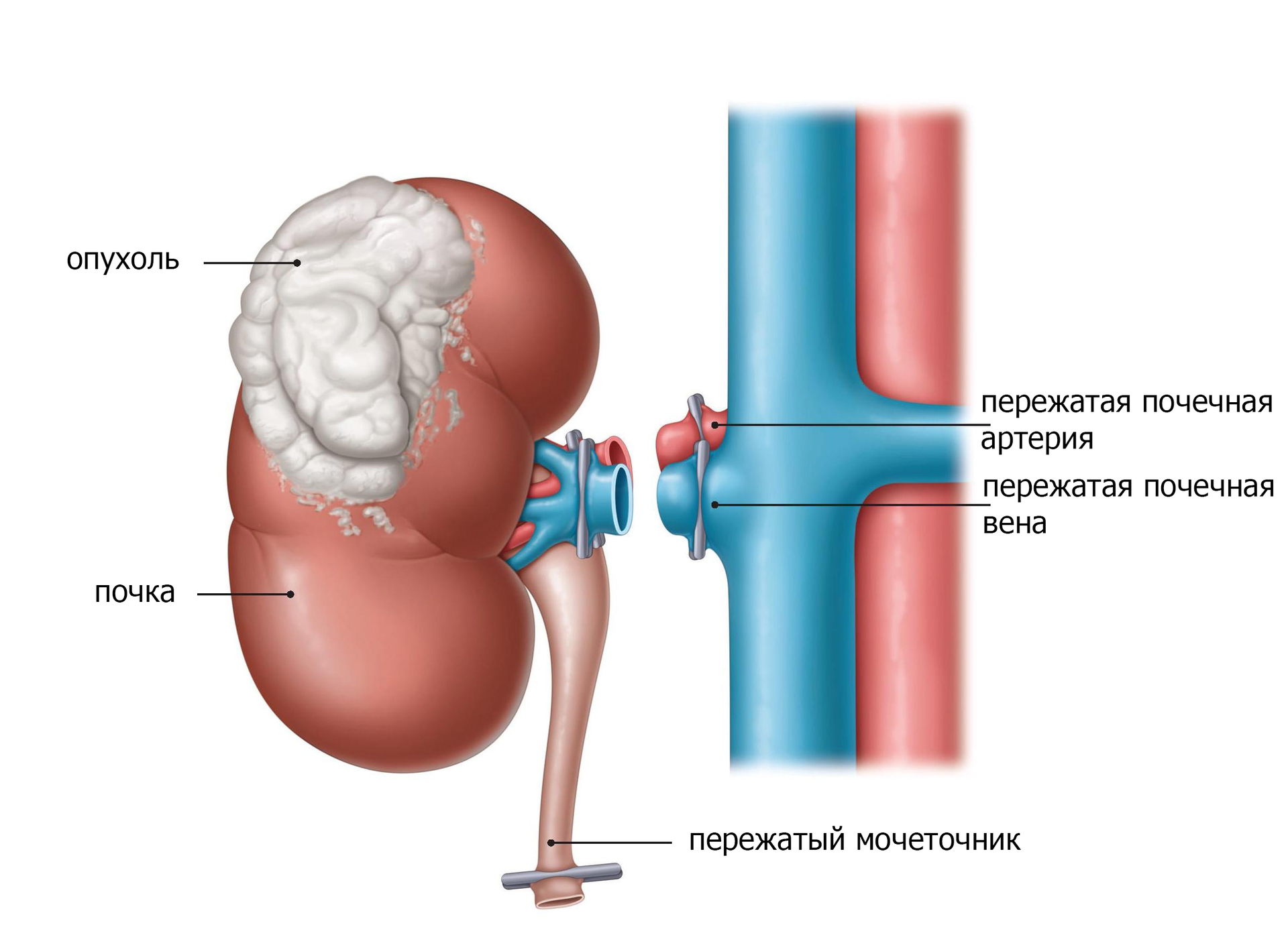 Полное удаление почки