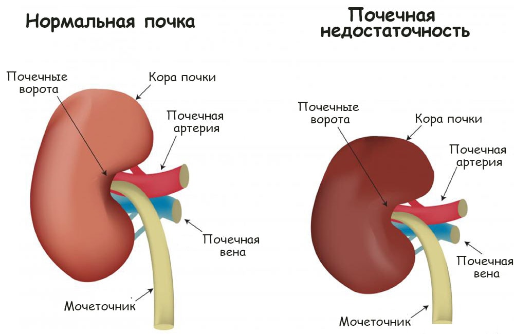 Нормальная почка и орган при почечной недостаточности