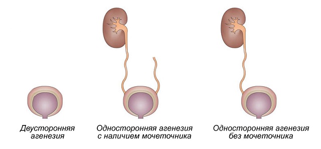 Агенезия (аплазия) почки