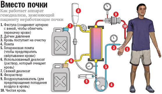 Принцип проведения гемодиализа