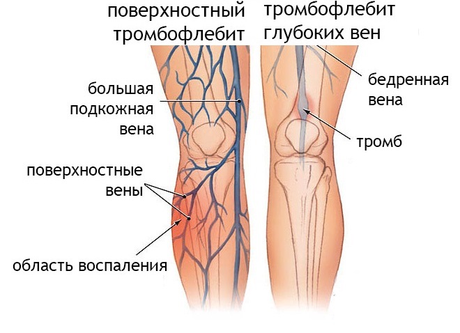 Тромбофлебит
