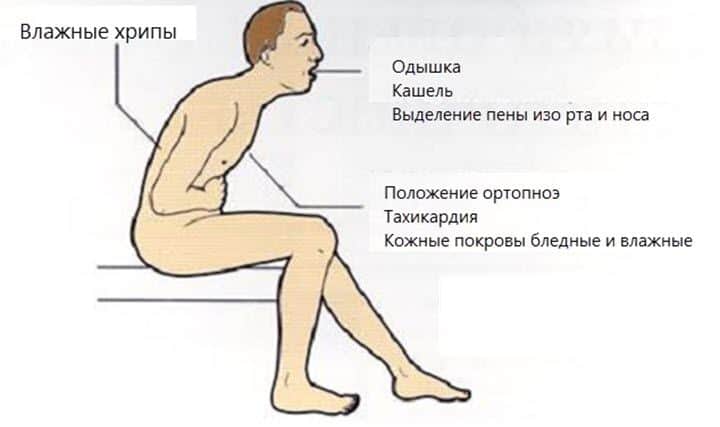 Появление пены изо рта свидетельствует о высокой тяжести проявления острой СЛН.