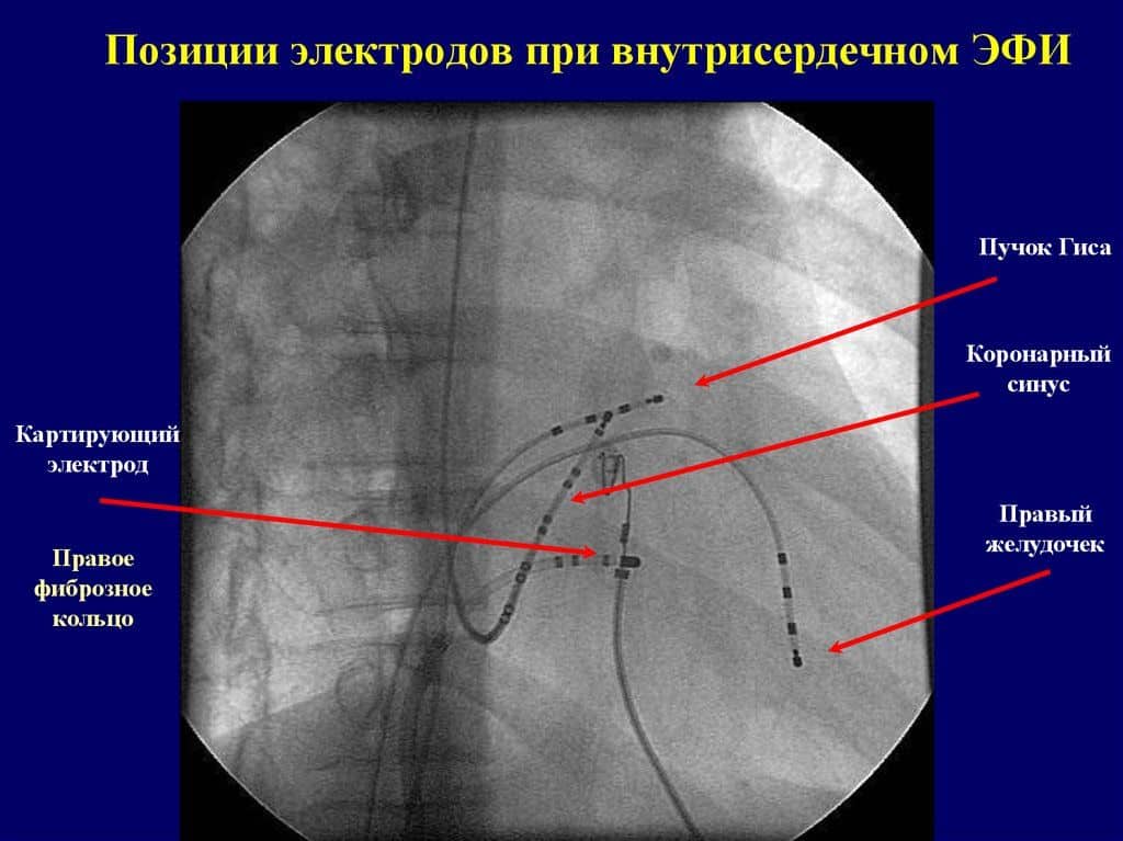 Позиции электродов при внутрисердечном ЭФИ