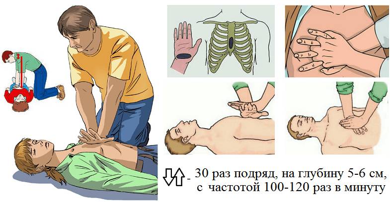 Правильная техника закрытого массажа сердца пострадавшему, старше 8-летнего возраста