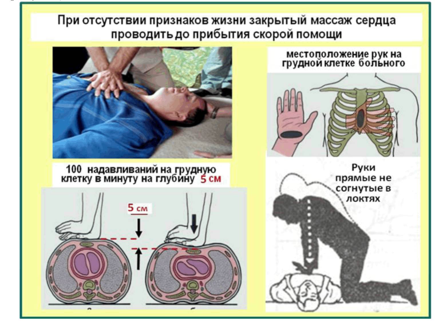 При отсутствии дыхания и сердцебиения реанимационные мероприятия проводятся до прибытия медиков