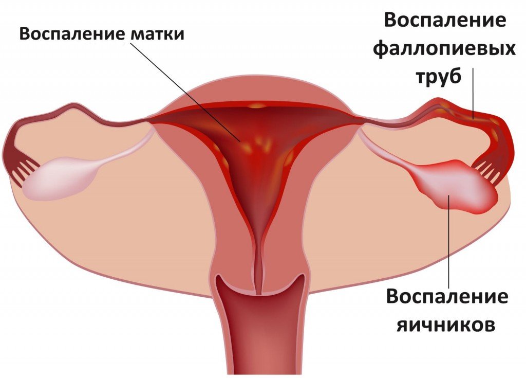 Причины альгодисменореи