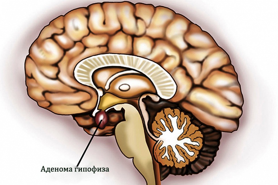 Причины галактореи