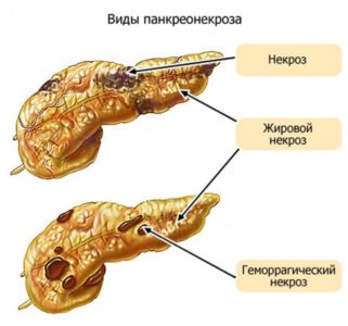 Причины развития и лечение геморрагического панкреатита