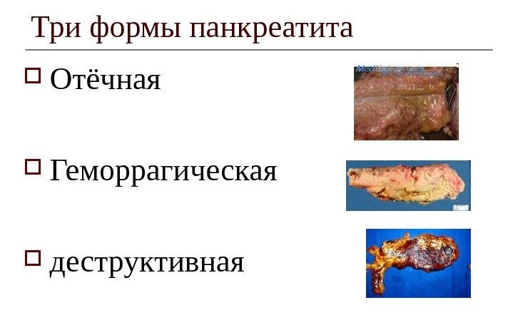 Причины развития и лечение геморрагического панкреатита