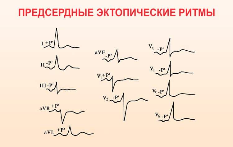 Пример того как выглядят эктопические ритмы