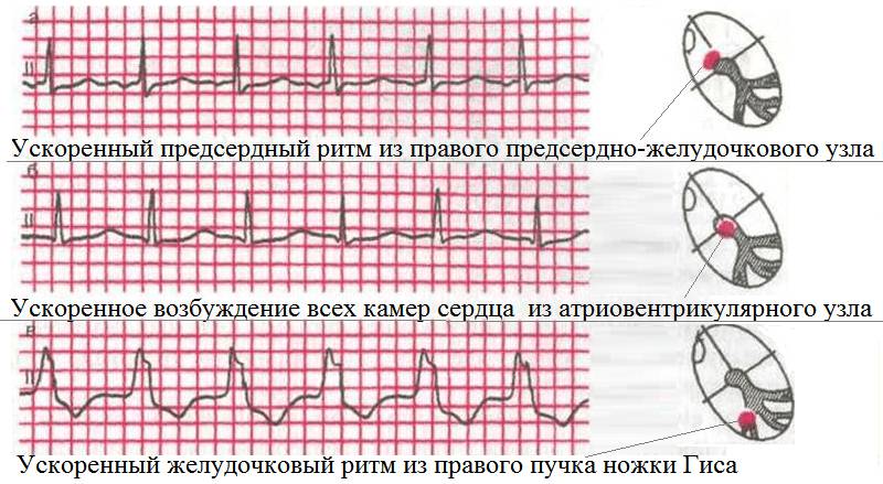 Примеры патологических вариантов ритма сердца