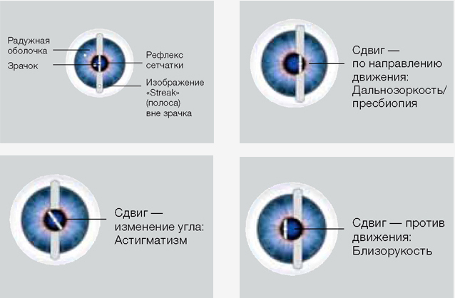 Принцип скиаскопии