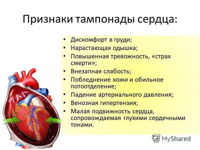 Признаки тампонады