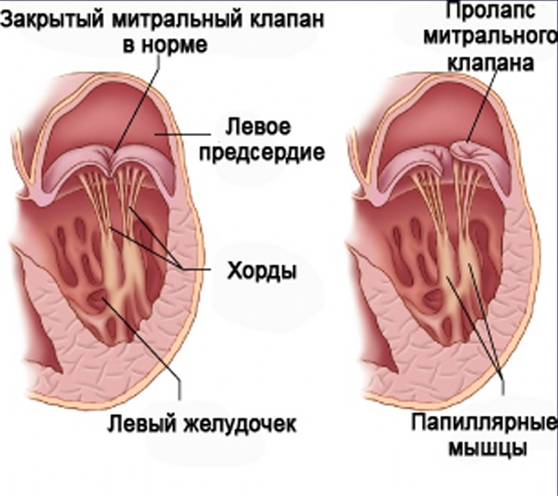 Пролапс митрального клапана