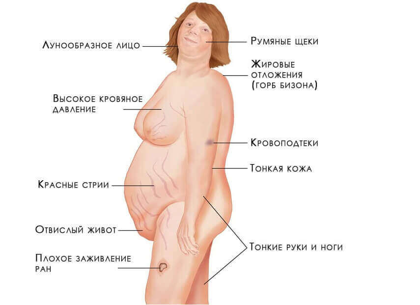 Проявления кортикостеромы