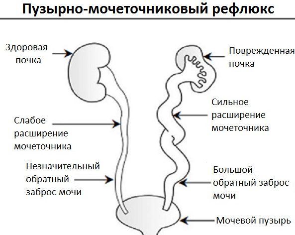 Пузырно-мочеточниковый рефлюкс (схема)