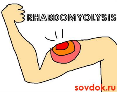 рабдомиолиз