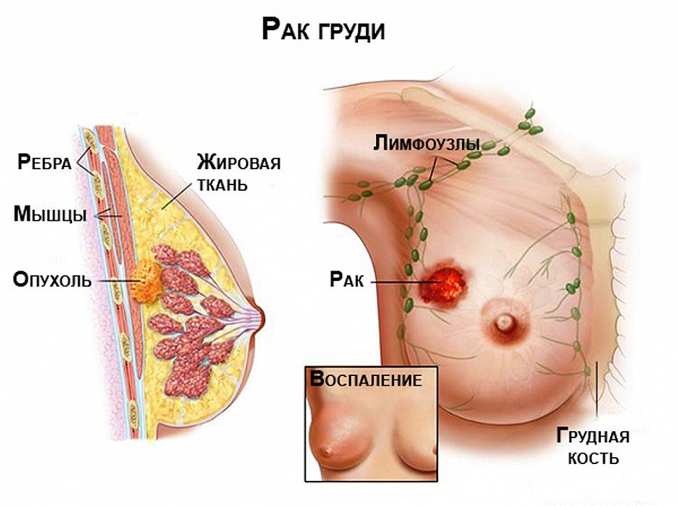 Злокачественная опухоль в груди