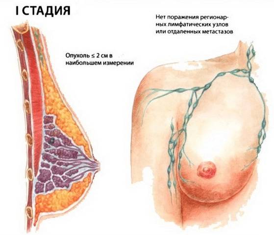 рак молочной железы 1 степени
