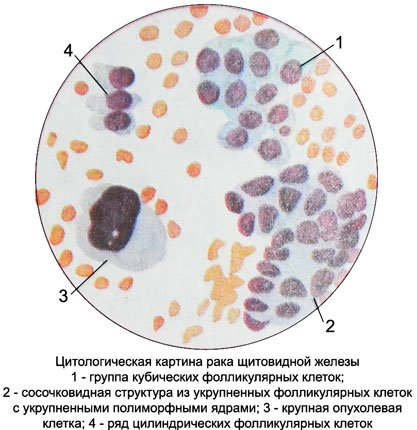 Цитология рака щитовидной железы
