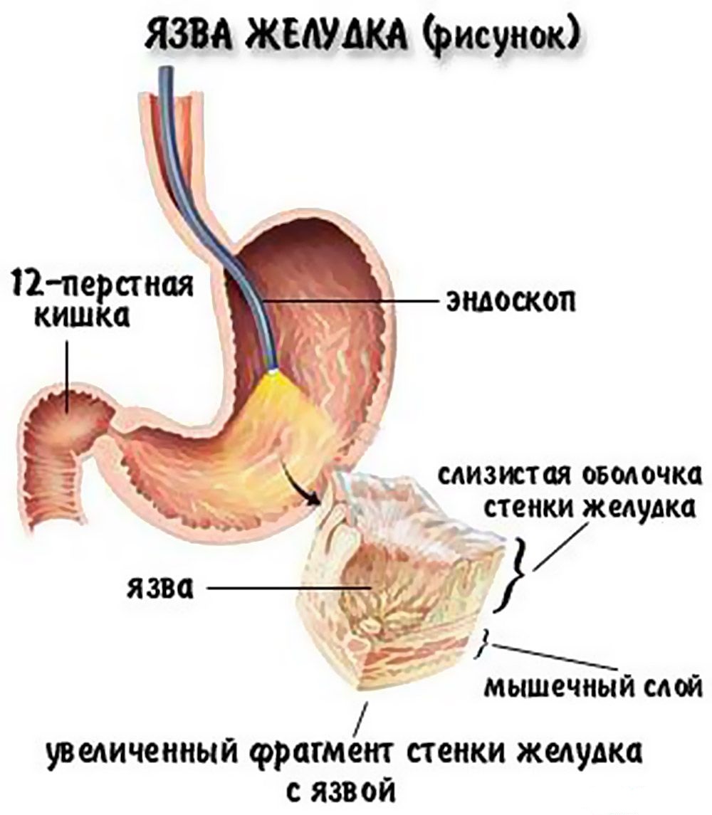 расположение язвы желудка
