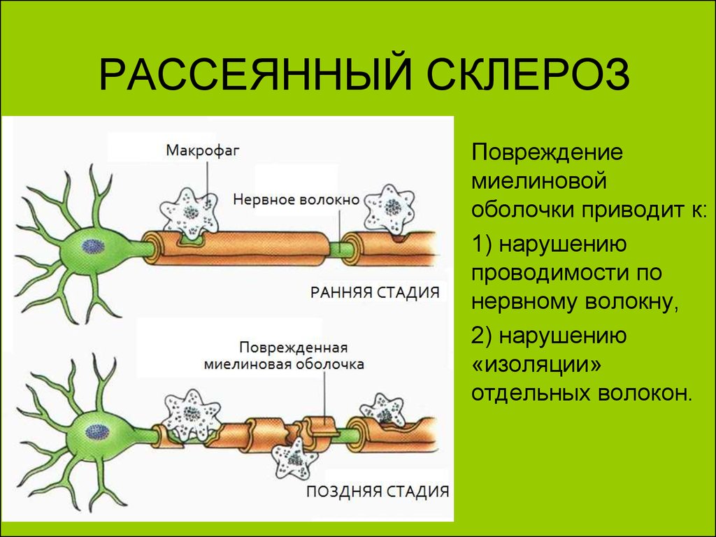 Рассеянный склероз (изображения повреждённой миелиновой оболочки на ранней и поздней стадиях)
