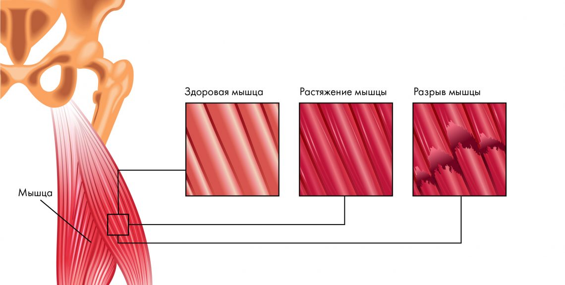 Растяжение мышц