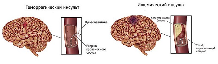 Различие двух видов инсультов