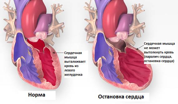 Различие между работающим и остановившимся сердцем