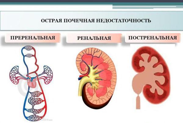Различные виды развития острой почечной недостаточности