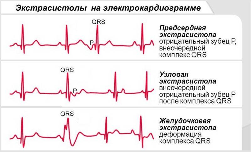 Разновидности экстрасистолии