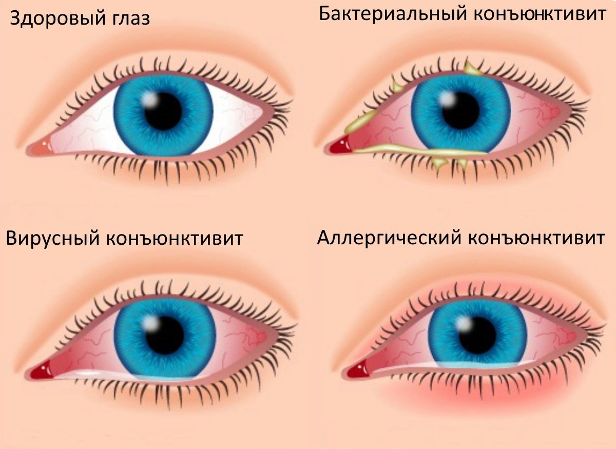 разновидности конъюнктивита