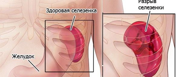 Разрыв селезенки требует незамедлительной госпитализации больного и предоставления ему хирургической помощи.